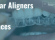 clear aligners