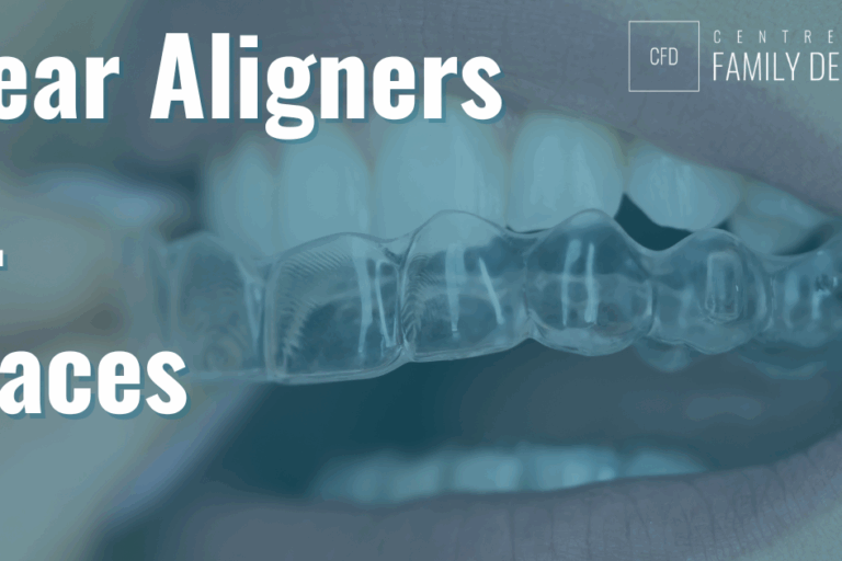 clear aligners