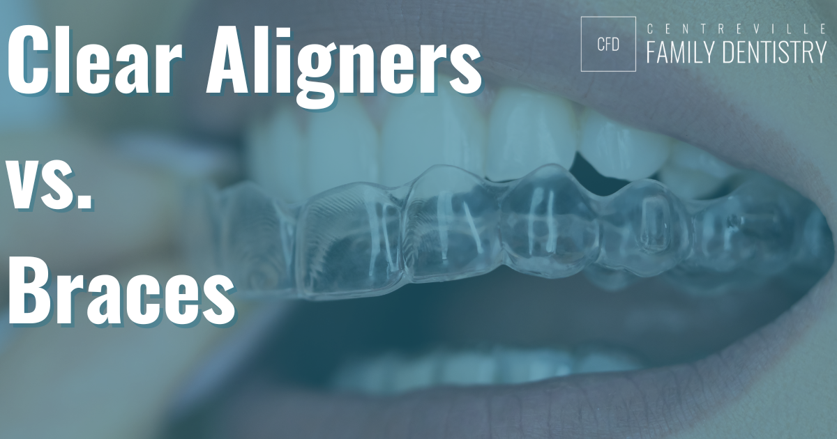 alignersrectangle clear aligners