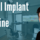 dental implants