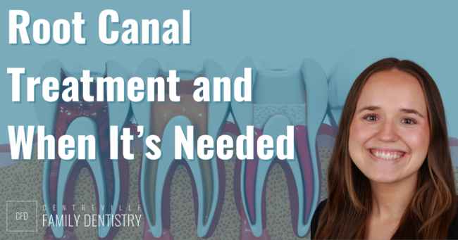 root canal