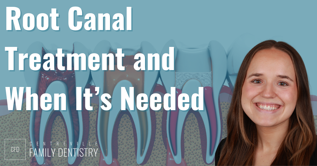 root canal