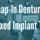snap-in dentures vs all on 4 implant teeth