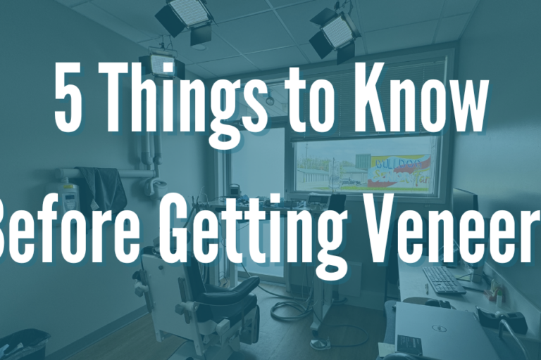 things to know before getting veneers