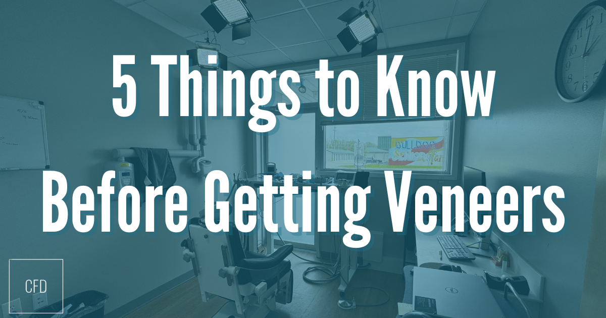 things to know before getting veneers